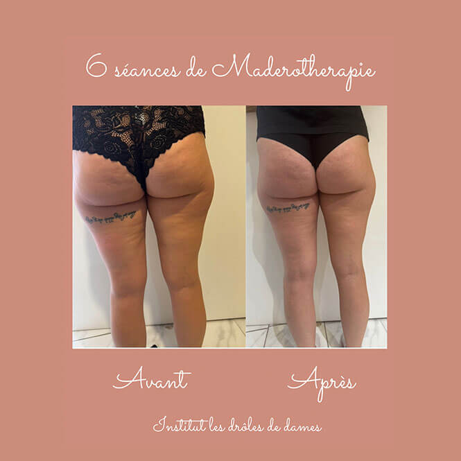 Madérothérapie Orliénas